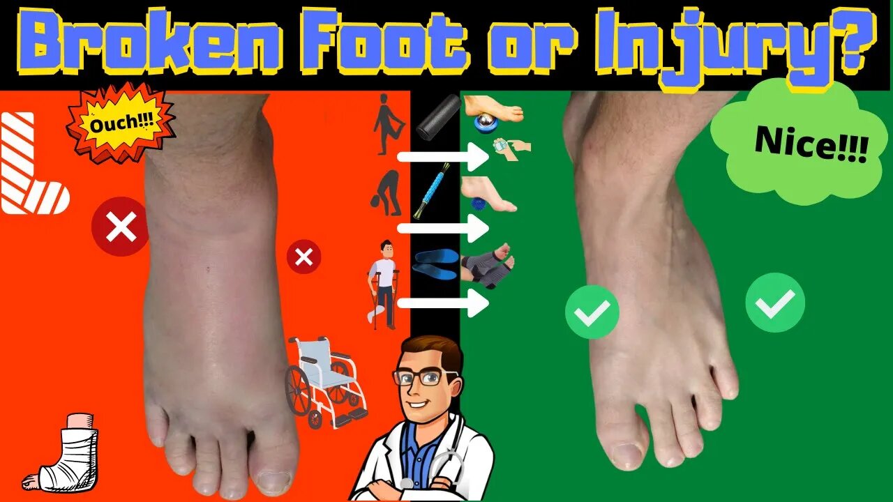 [25 MUST DO Recovery Tips]: Broken Foot | Sprain | Stress Fracture