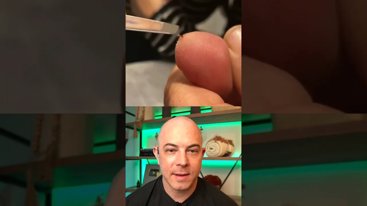 Doctor reacts to MASSIVE splinter in big toe! #dermreacts #doctorreacts #splinter #splinterremoval