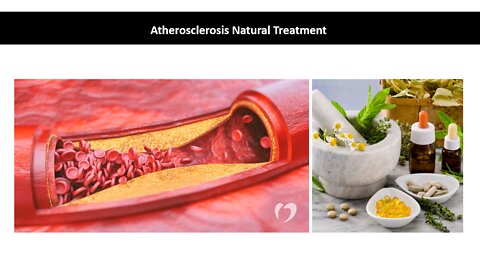 Atherosclerosis Natural Treatment