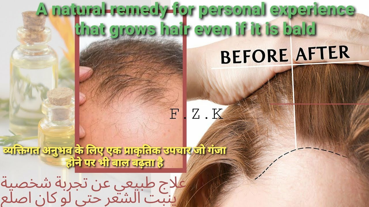 A natural treatment based on personal experience to regrow hair and fill in voids in a short time