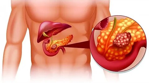 PRINCIPAIS SINTOMAS E CAUSAS DO CÂNCER DE PÂNCREAS QUE VOCÊ NÃO SABIA 😳😳