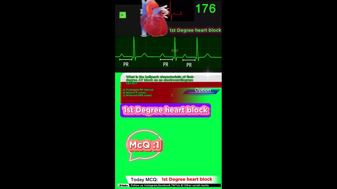 First degree heart blockages #firstdegreeavblock #arrthymias #CardiacArrhythmia #Cardiology