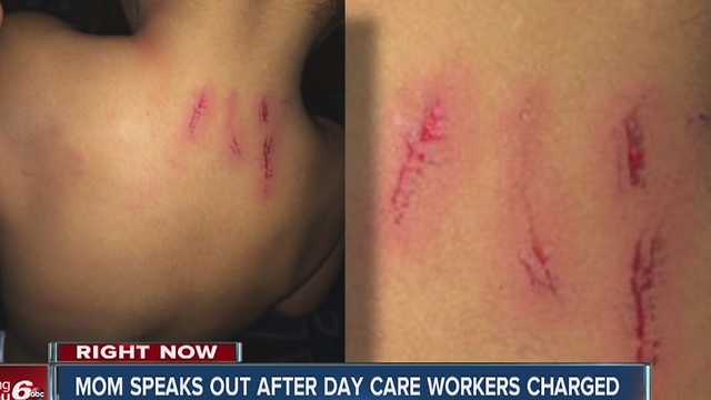 Mother speaks out after toddler injured by older child while at day care