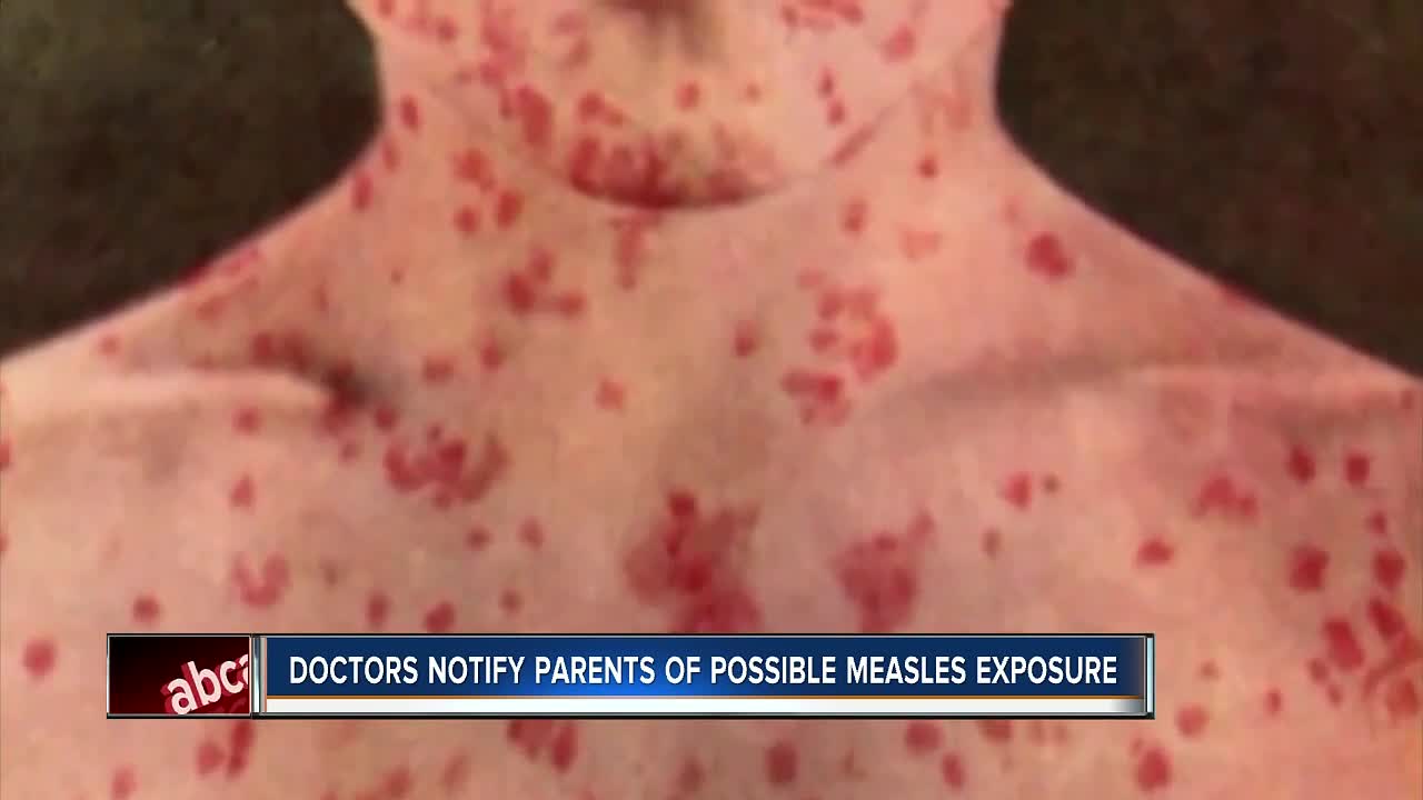 Doctors notify parents of potential measles exposure in Pinellas County