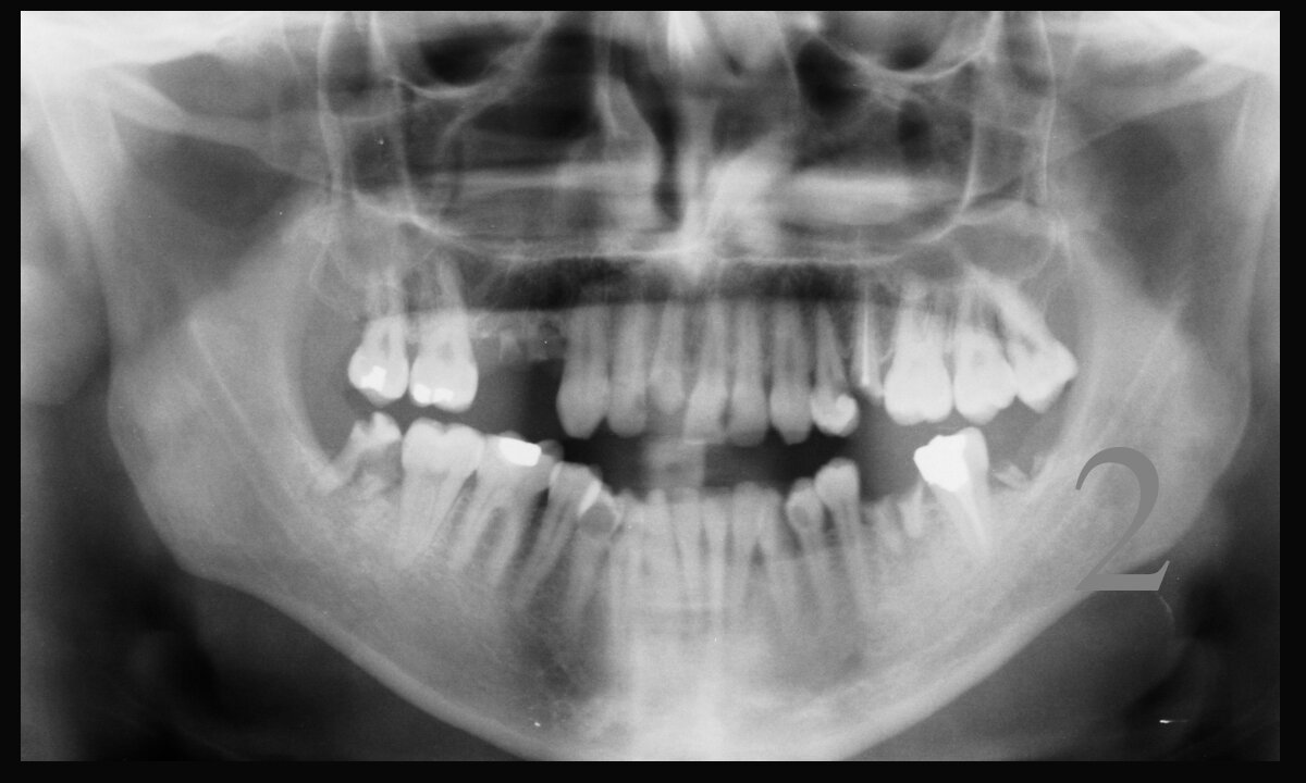 CURE TOOTH DECAY, ВЫЛЕЧИТЬ ЗУБЫ (часть 2)