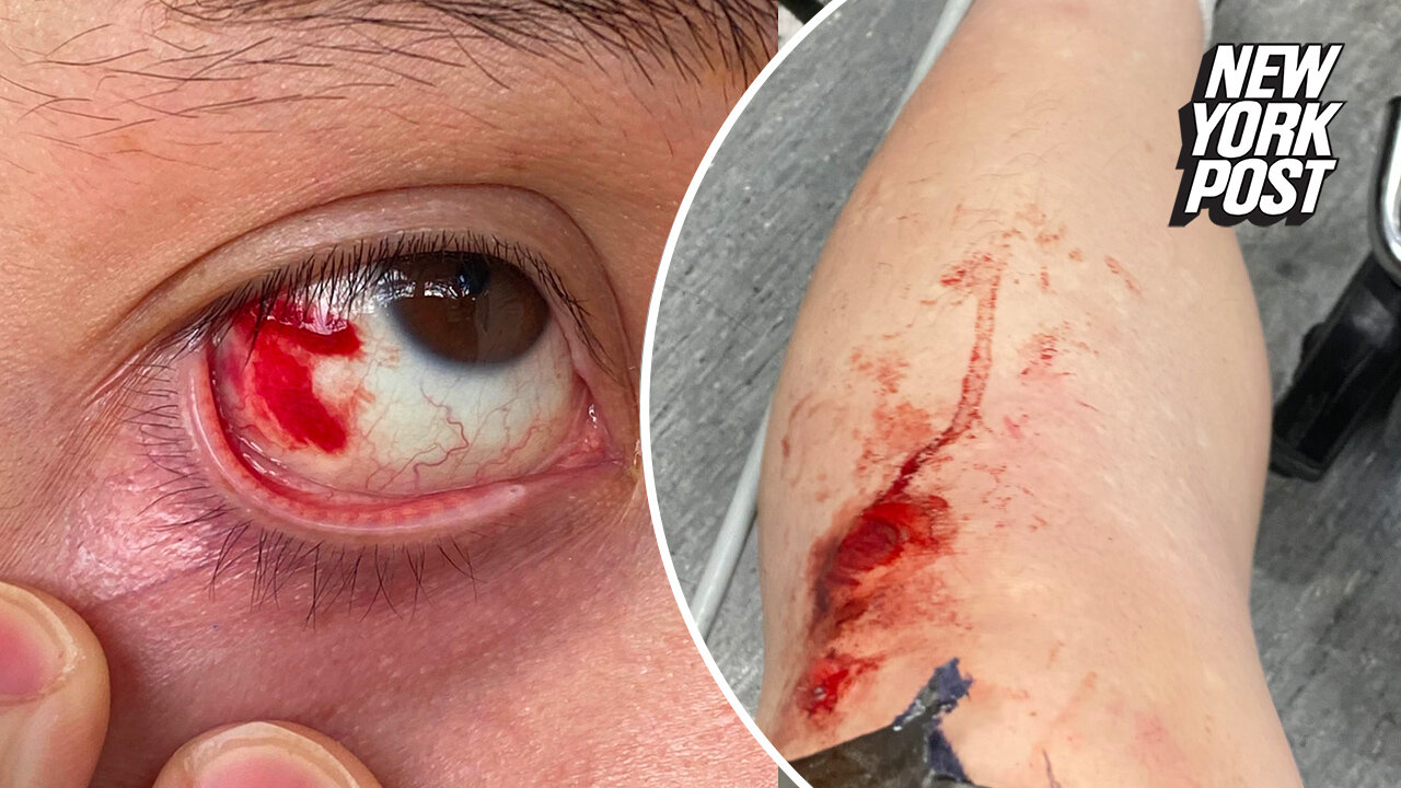 Author Andy Ngo who exposed Antifa says he was beaten by 'masked mob'