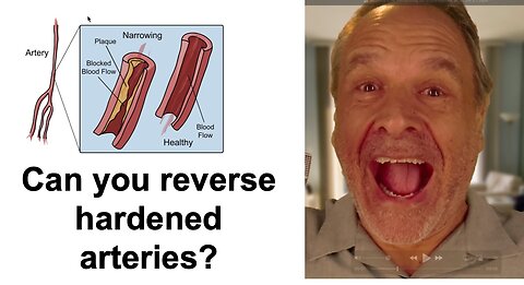 Can you reverse hardening of the arteries?