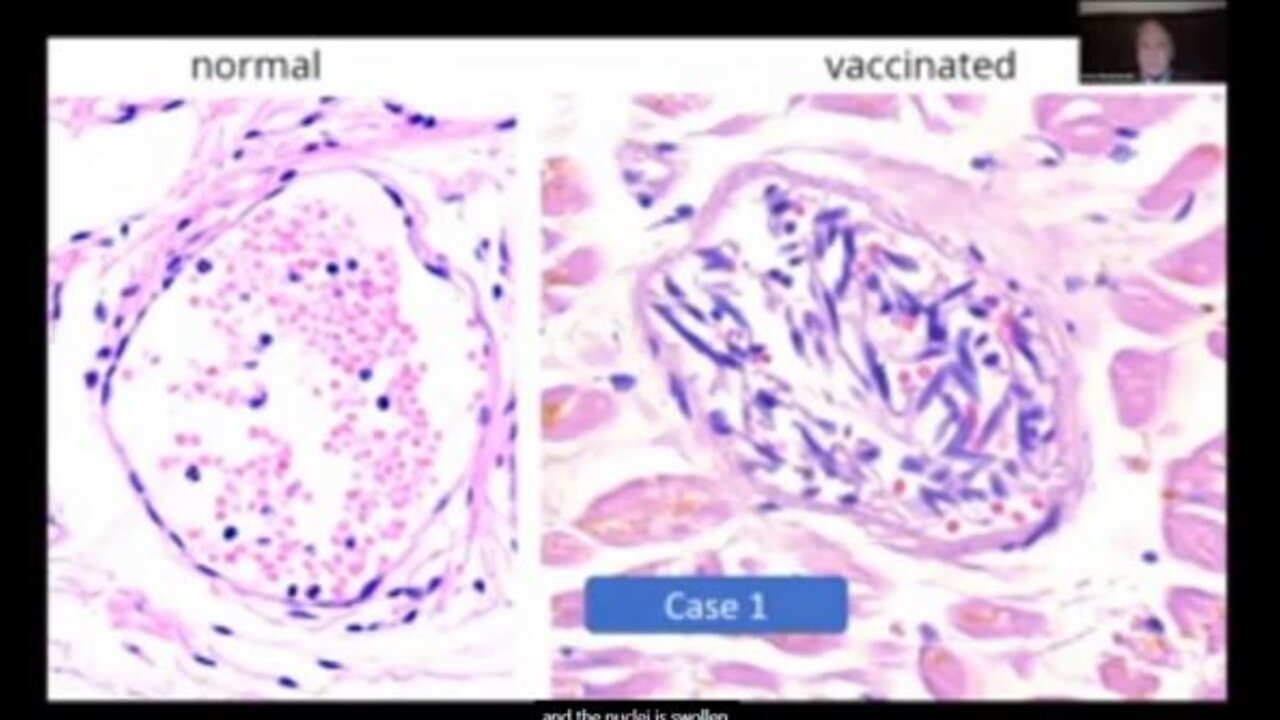 AUTOPSIES - Vaccine CAUSE of DEATHS part 1