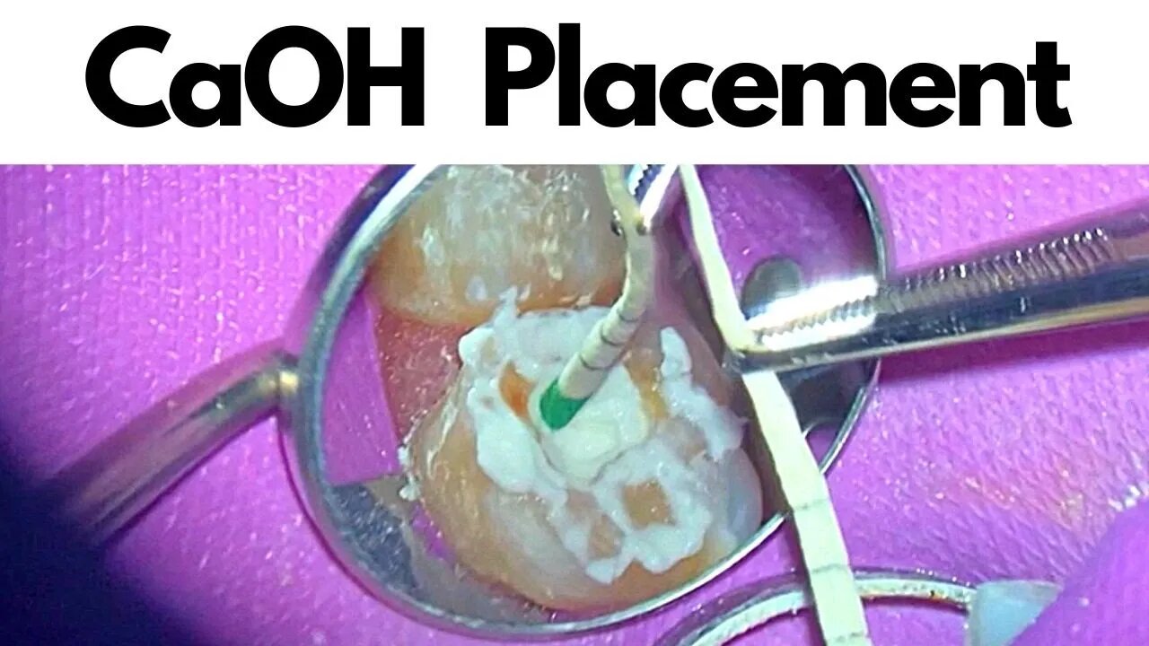 Calcium Hydroxide: HUGE Apical Lesion Max Molar