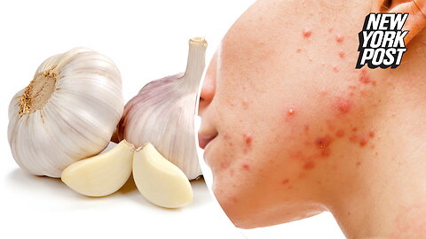 Beauty influencers are rubbing garlic on their faces to clear acne