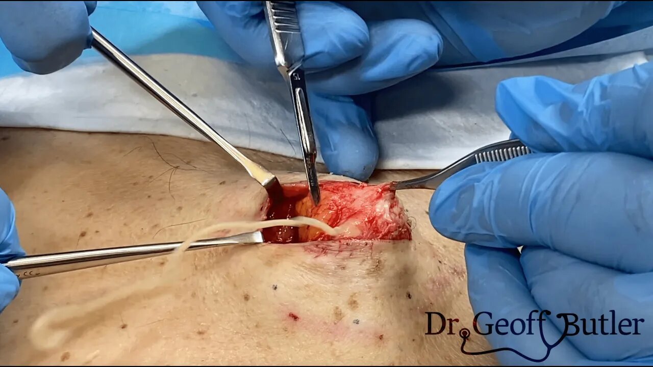 Epidermal Cyst Removal on Upper Back