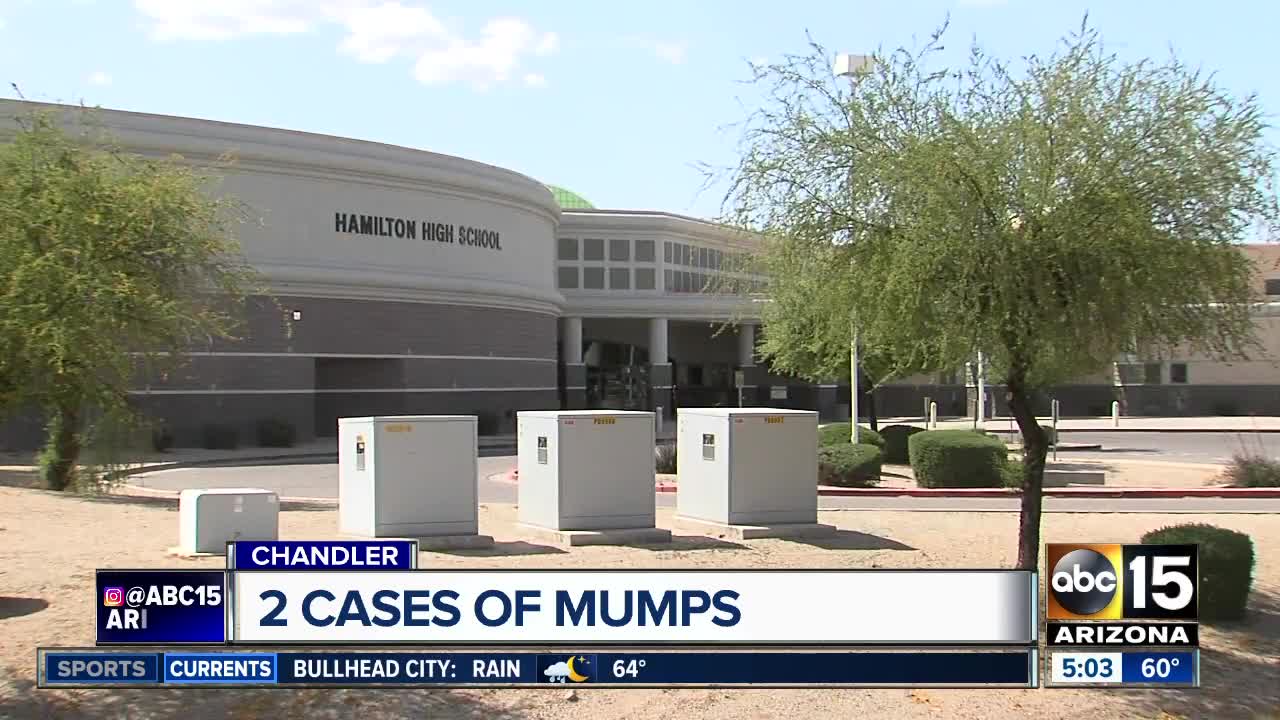 Mumps in Maricopa County: What to know