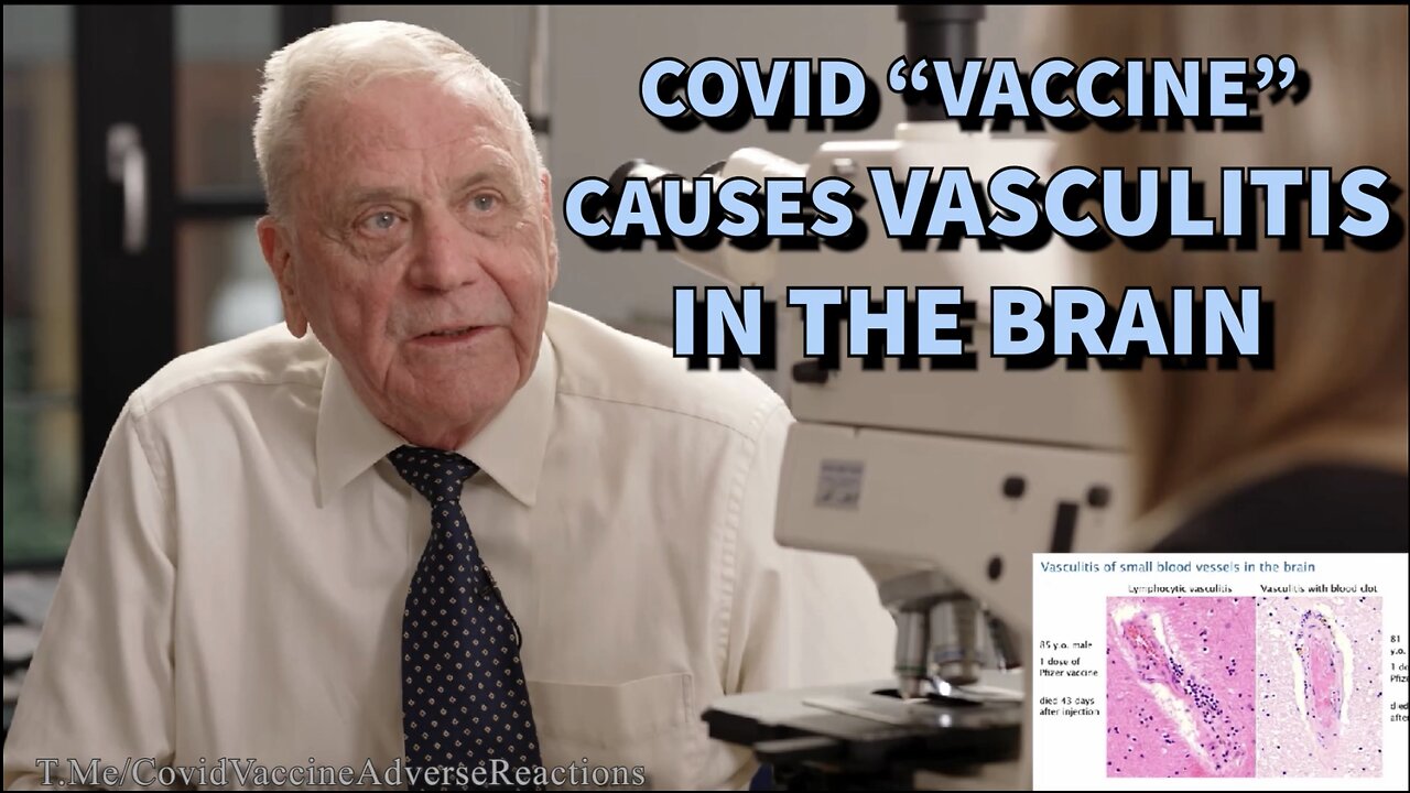 Dr. Burkhardt Revealed Vasculitis In Brain of Almost All Autopsy Reports After Covid "Vaccination"