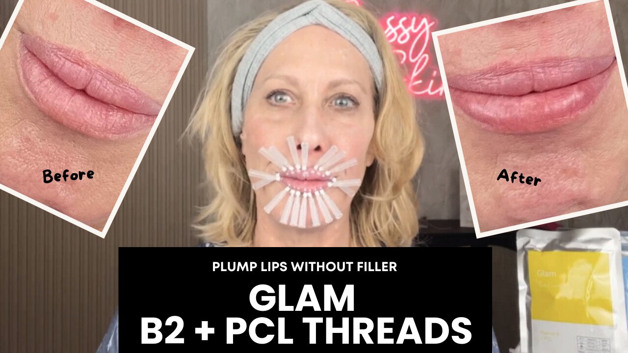 Plump Lips Without Filler - Glam B2+PCL Threads