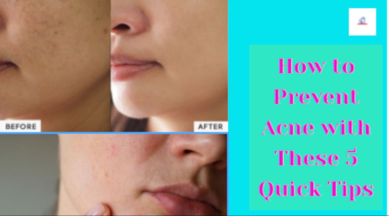 How to take care of Prevent pimples oily skin