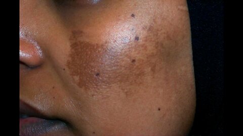 Melasma