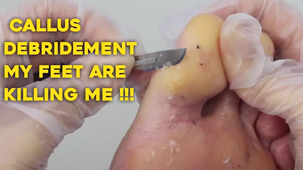 Foot Callus?? CALLUS DEBRIDEMENT - ODDLY SATISFYING - My Feet are Killing Me !!!