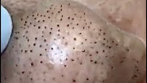 Blackheads.black hair acne.