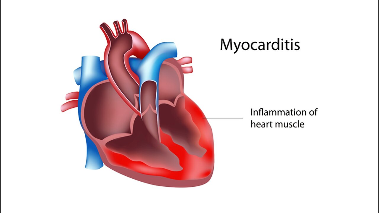 Myocarditis 38 Year Old