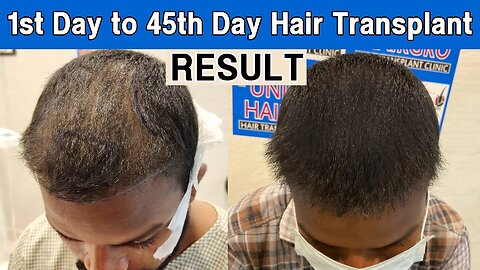 45th Day Hair Transplant Result