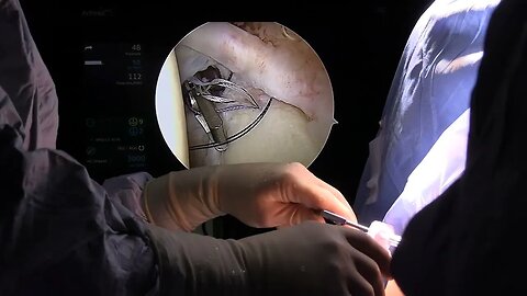 Shoulder Arthroscopy - Scott A. Barbour, M.D.