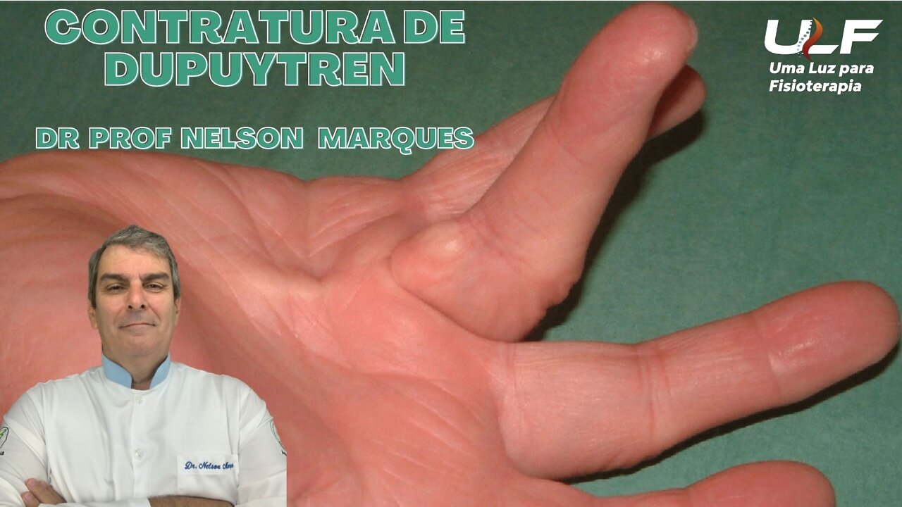 CONTRATURA DE DUPUYTREN - Dr. Prof. Nelson Marques