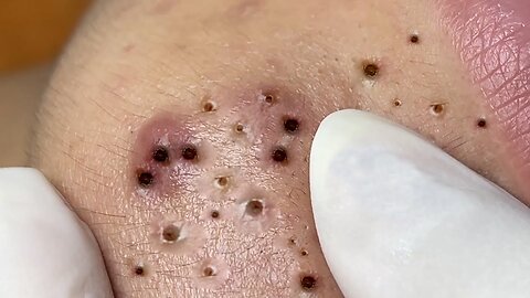 Popping Tons Of Blackheads Satisfying extreme Blackhead Removal