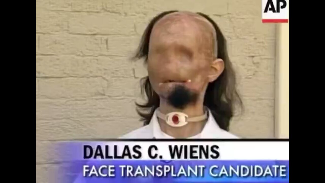 Dallas Wiens Undergoes Full Face Transplant After Severe Burns