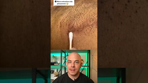 Derm reacts to armpit cyst pops! #dermreacts #doctorreacts #pimplepop #cystpop