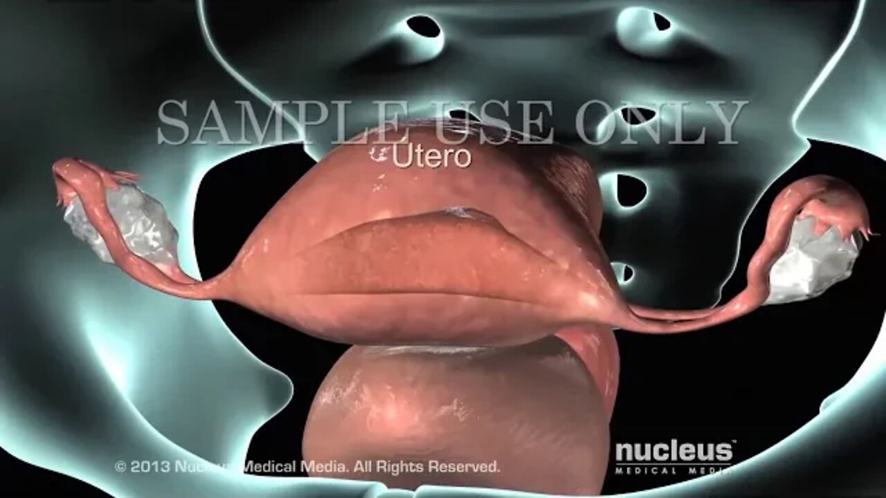 Biopsia endometrial