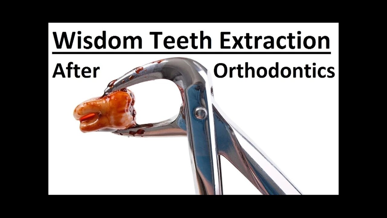 Why Is It Sometimes Recommended To Extract Wisdom Teeth After Orthodontic Treatment by Dr Mike Mew