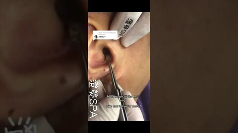 Huge Blackhead removal inside the Ear 👂 #oddlysatisfying