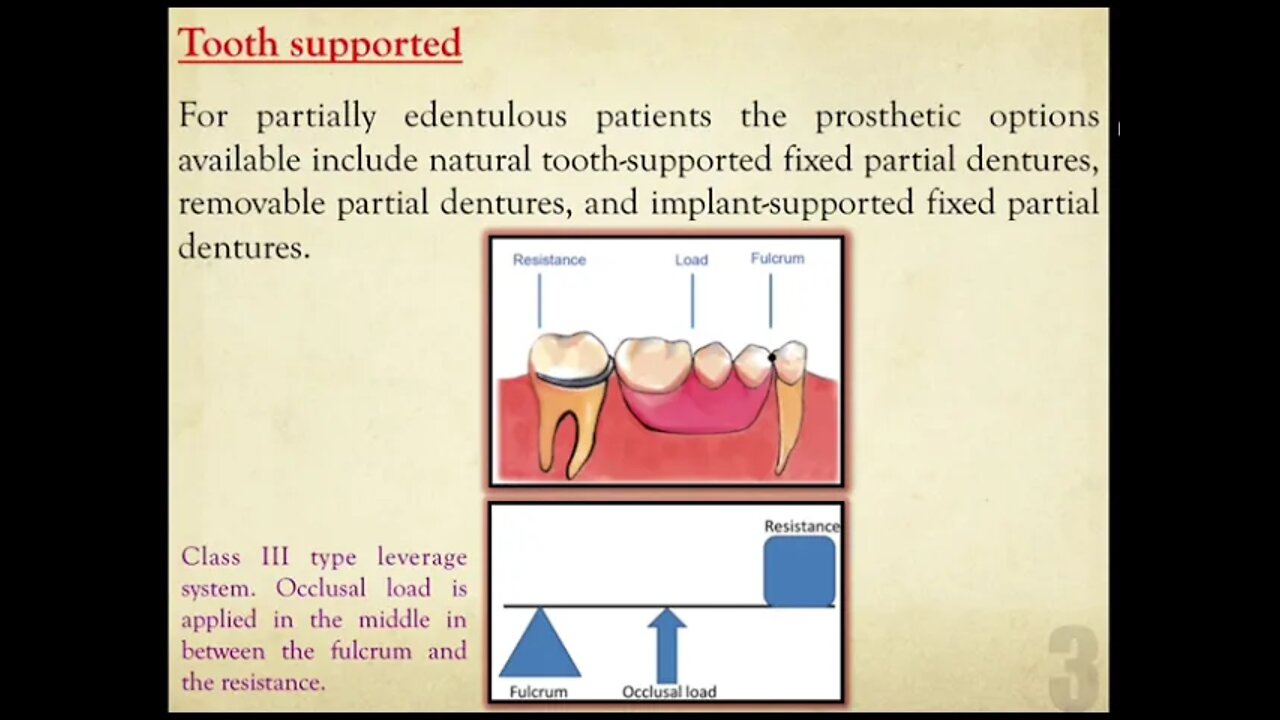 Prosthodontics L2 (Classification Of Partially Edentulous Arches)