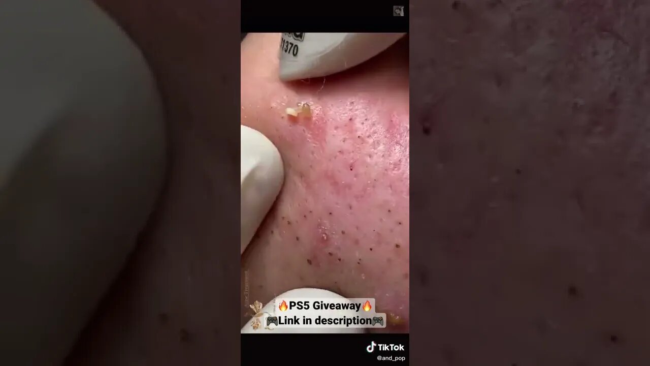 Tons of blackheads popping out like worms 🫣 #shorts #blackheadremoval #blackhead #blackheads #fyp