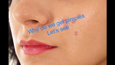 Why do we get pimples let’s see