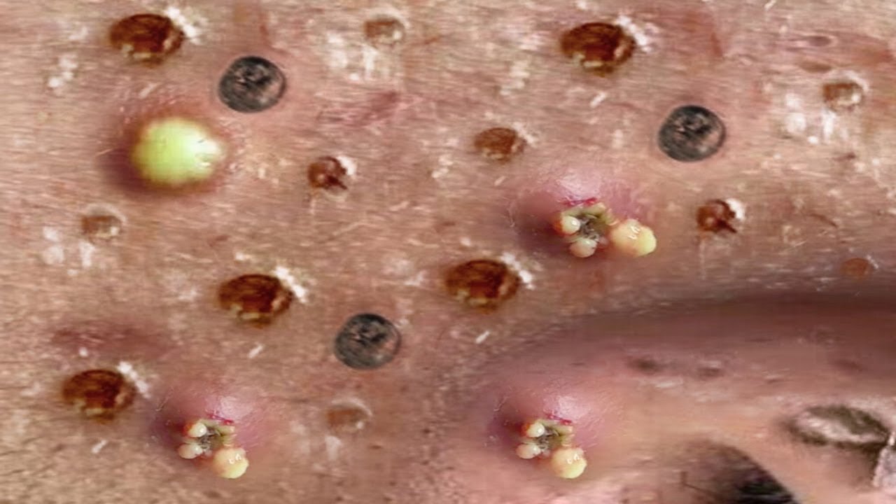 Blackheads, Blackhead Removal, Acne Extraction Relaxing #62