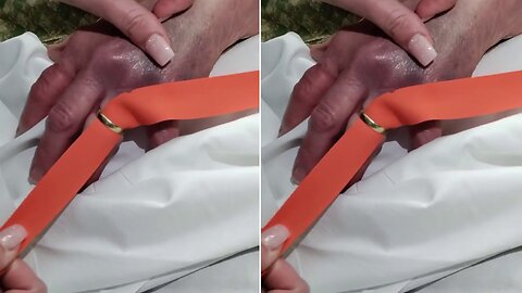 Removes A Tight Ring With A Tourniquet !