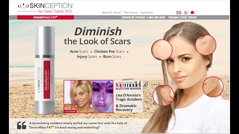 HOW I GET RID MY ACNE SCARS