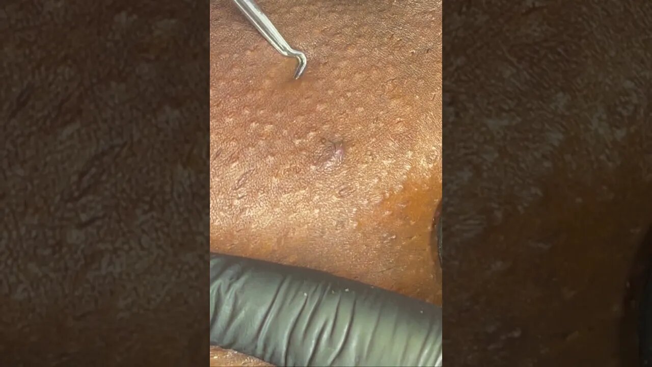 Remoção de Cravos e Espinhas - Just Relax | Apenas Relaxe
