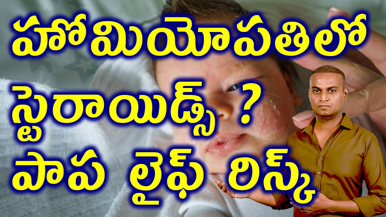 హోమియోపతి మందుల్లో స్టెరాయిడ్స్ ఉంటాయా? Steroids in Homeopathy? Atopic Dermatitis case study