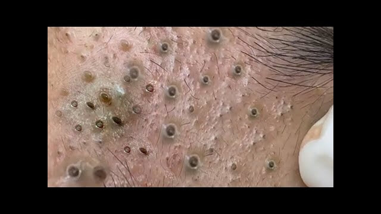 Blackheadsa Removal & Pimple Popper Cystic Acne Extraction Whiteheads Pimple Popping 112