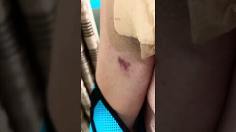 One of my Surgery Scars have Healed!!