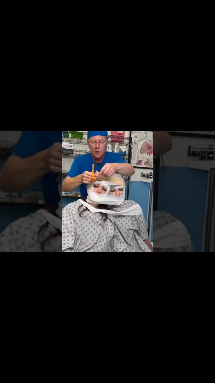 Conjoined twins separation reveal!