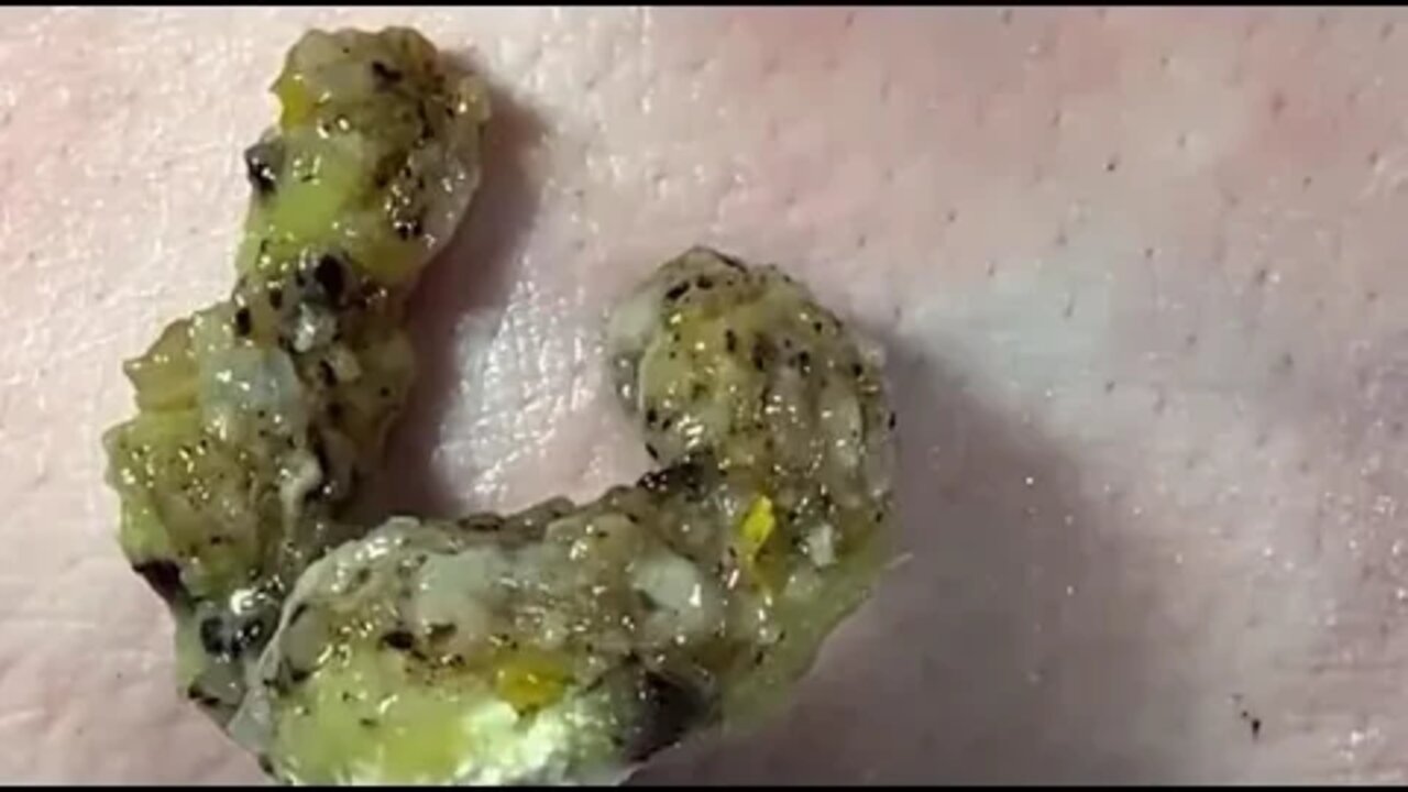 WTF this MASSIVE blackhead can't be real!? 😱😰 #blackheadremoval #blackhead #blackheads #fypage