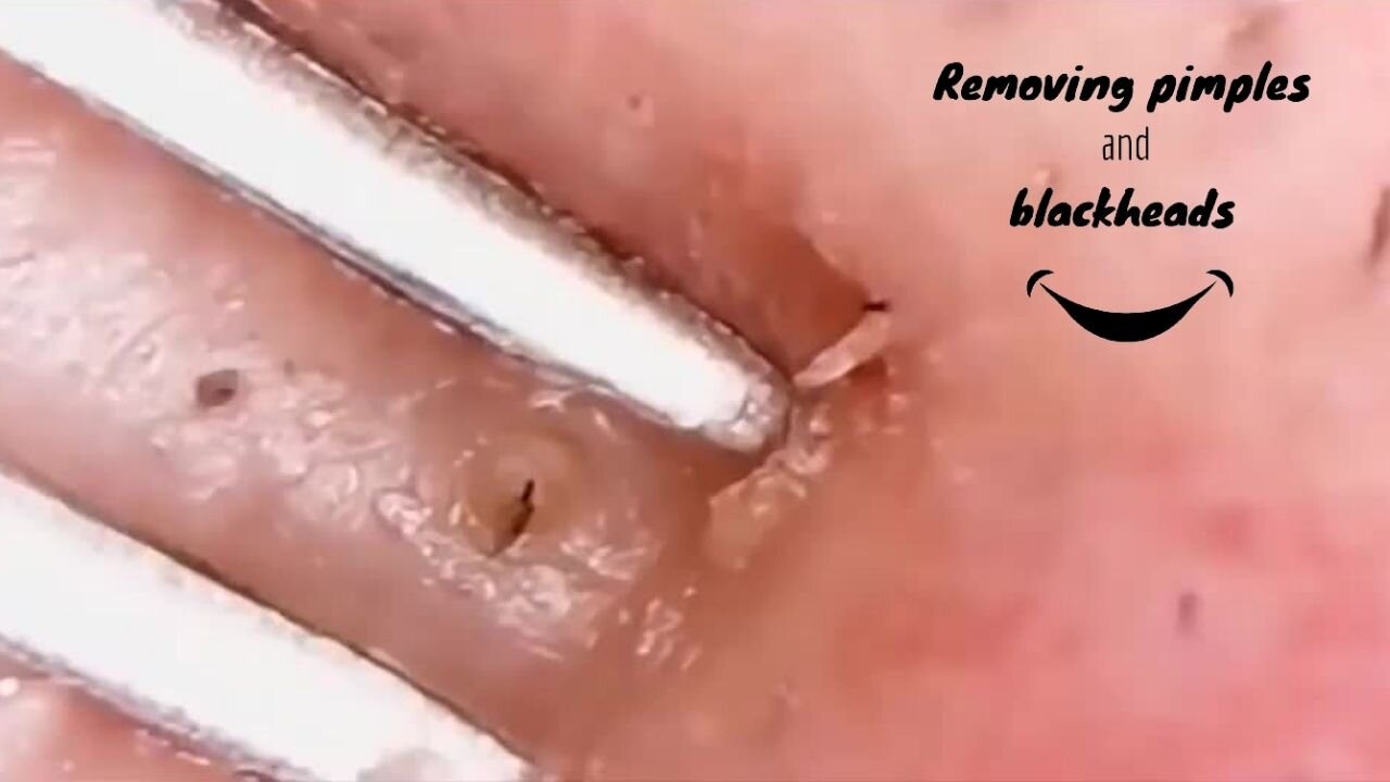 Satisfactory pimple removal, with zoom