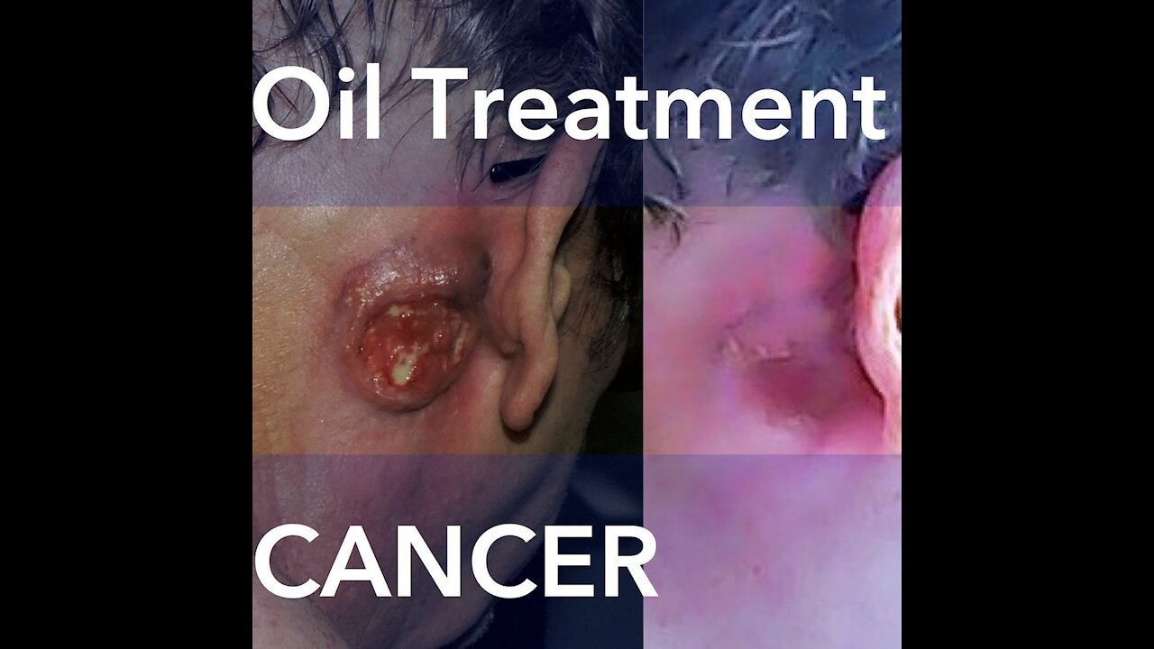 Episode 178: A Massive Infected Cancerous Tumor Behind His Ear Cleared With Cannabis Oil