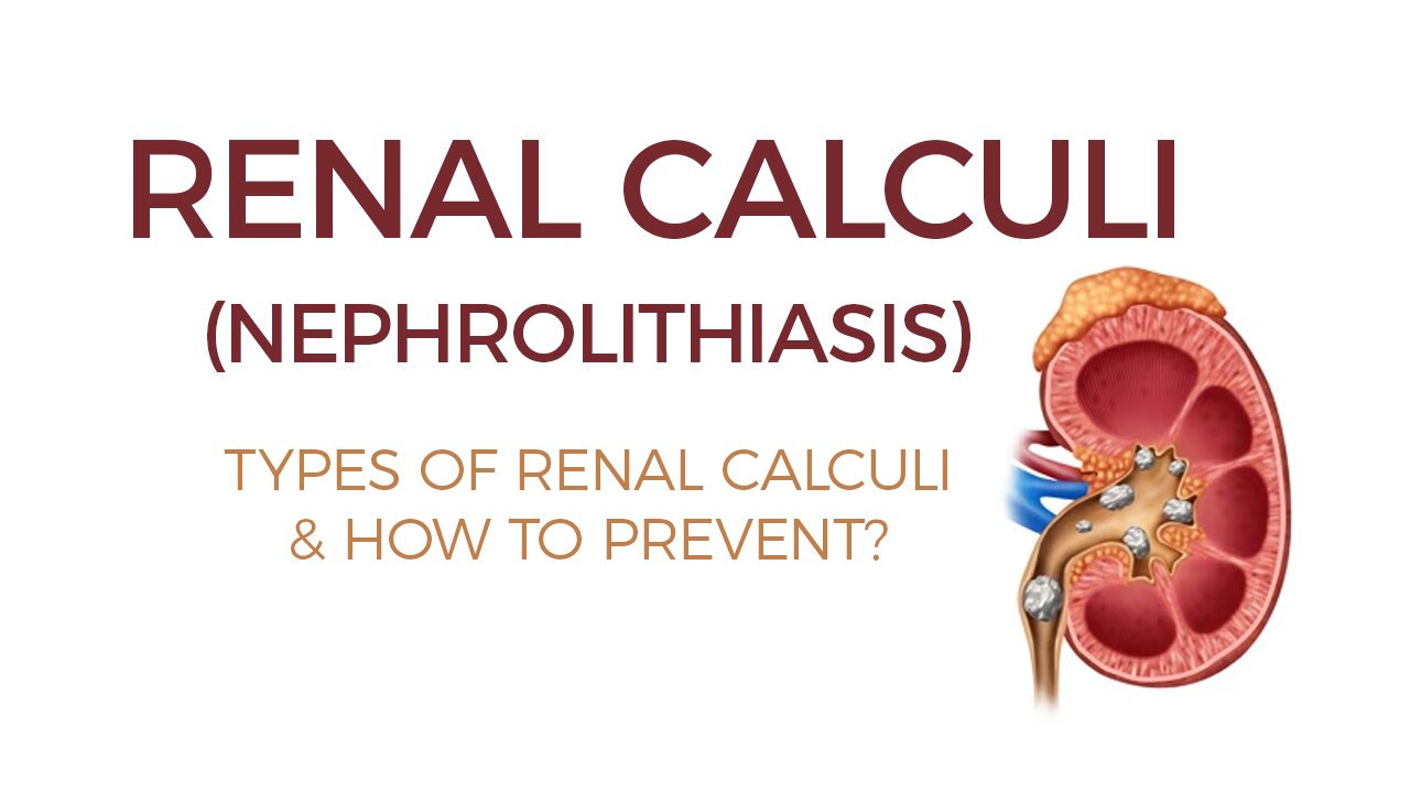 Types of Kidney Stones and How to Prevent their formation | Nephrolithiasis | Renal Calculi