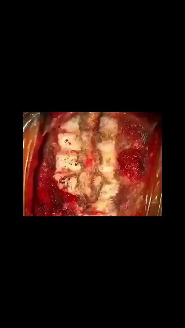 Operacje neurochirurgiczne kręgosłupa 🧐™