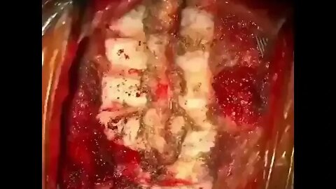 Operacje neurochirurgiczne kręgosłupa 🧐™