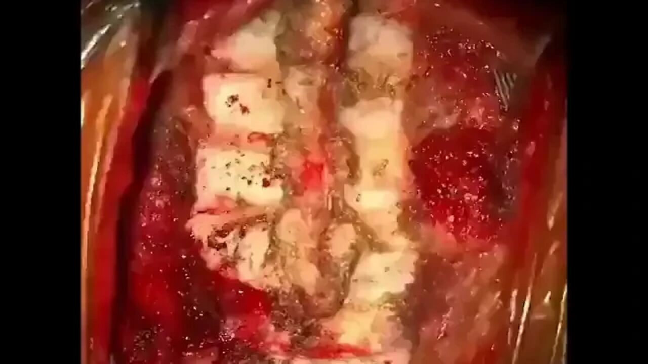 Operacje neurochirurgiczne kręgosłupa 🧐™